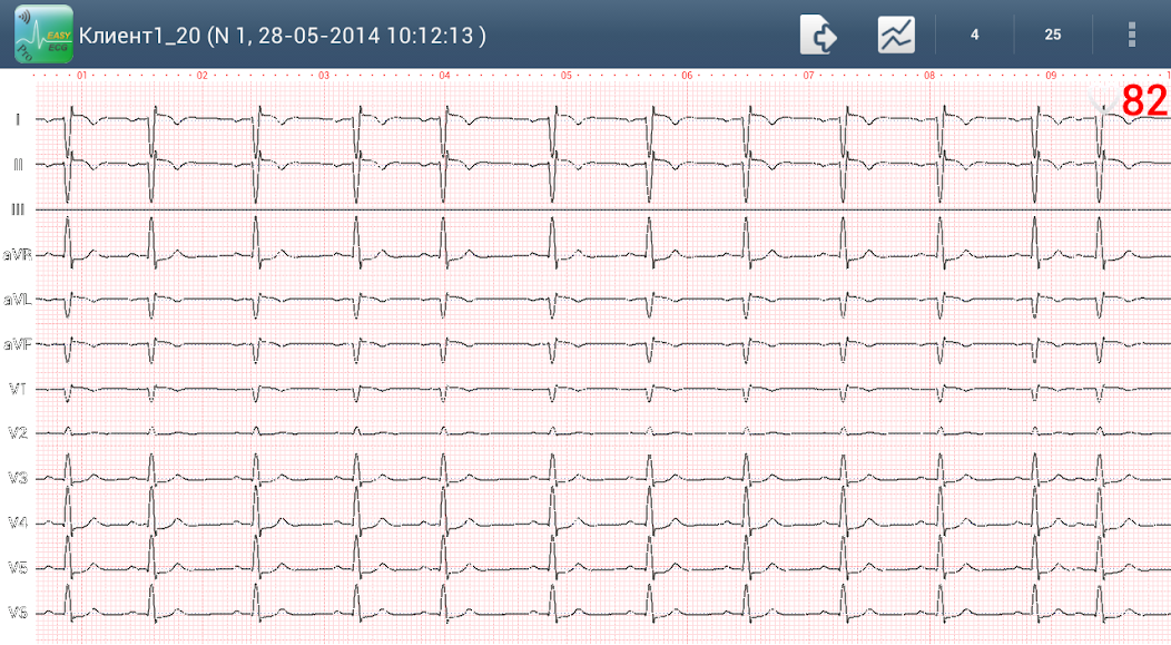 Easy ECG Mobile PRO