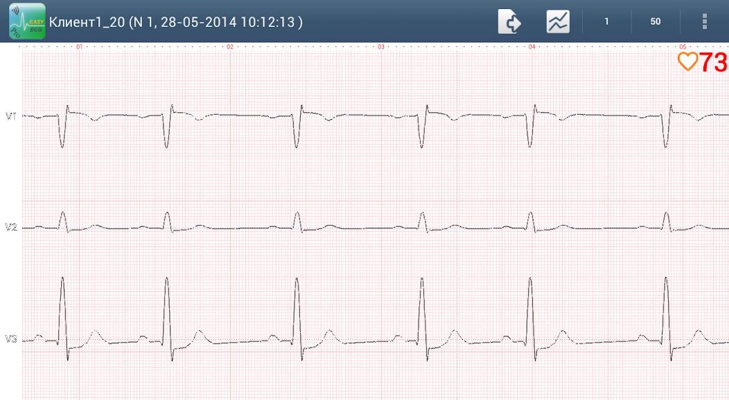 Easy ECG Mobile PRO