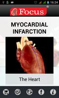 Myocardial infarction